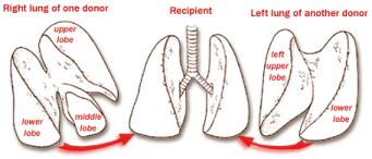 Living-Related Double Lobar Lung Transplant